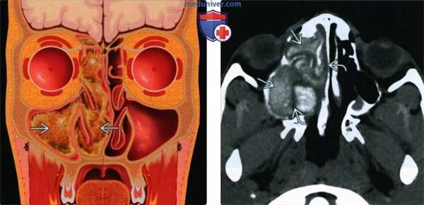 Аллергический грибковый синусит - лучевая диагностика