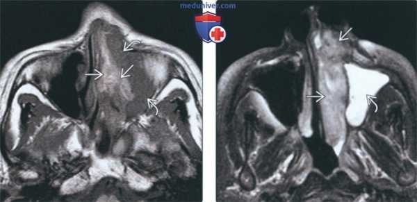 Лучевая диагностика меланомы носа и околоносовых пазух