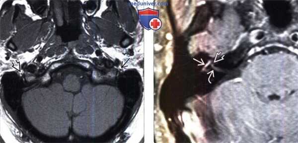 МРТ признаки паралича Белла