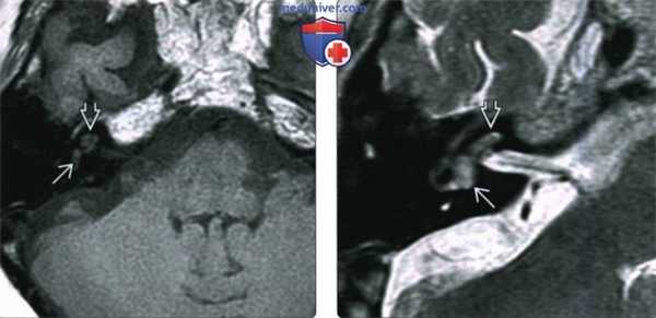 КТ, МРТ при интралабиринтной шванноме