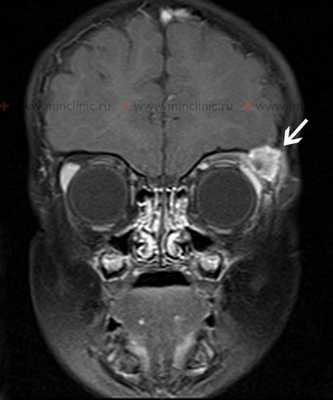 МРТ головного мозга и костей черепа с контрастирование - T1 взвешенное изображение на коронарном срезе демонстрирует эозинофильную гранулему как массу, накапливающую контраст, в области левой орбиты на уровне верхней части височной кости.