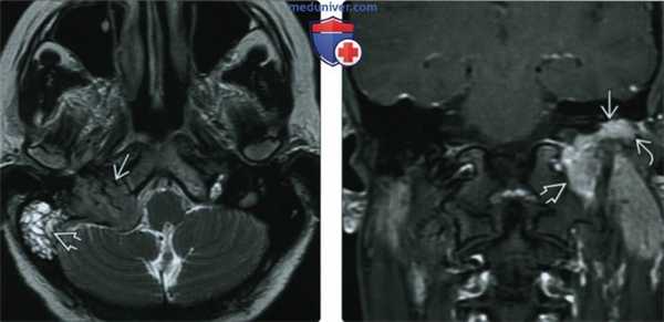 КТ, МРТ при параганглиоме яремного гломуса
