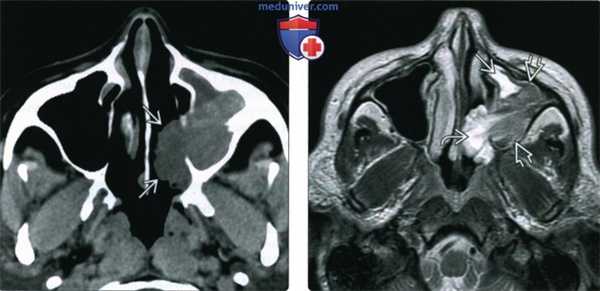 КТ, МРТ при синоназальной инвертированной папилломе
