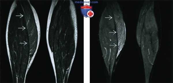 Денервационная гипертрофия - лучевая диагностика