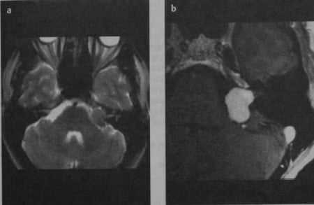 Снимки МРТ и КТ. Шваннома преддверно¬улиткового нерва
