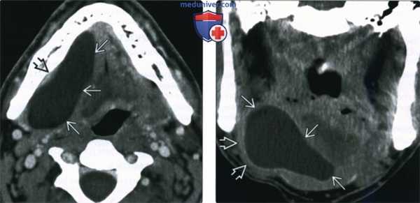 КТ, МРТ, УЗИ при рануле