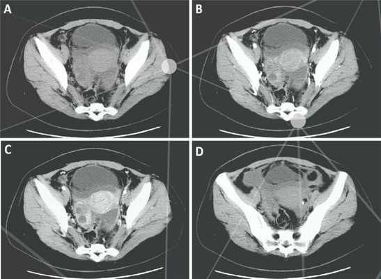 Что показывает КТ предстательной железы