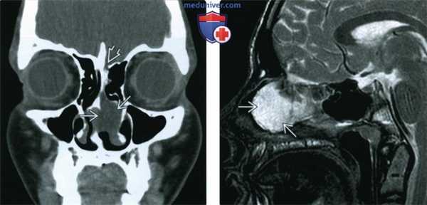 КТ, МРТ при фронтоэтмоидальном цефалоцеле