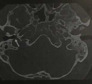 Снимки МРТ и КТ. Дегисценции яремной луковицы