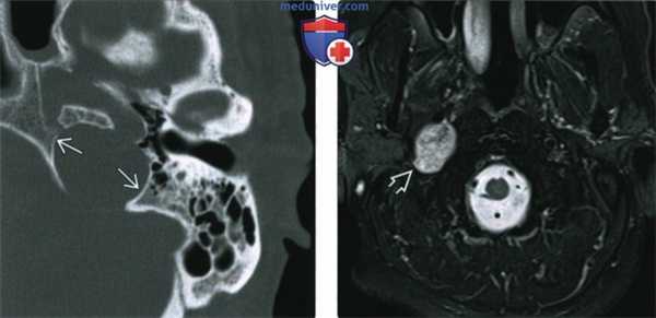 КТ, МРТ при шванноме яремного отверстия