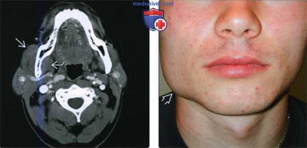 Доброкачественная гипертрофия жевательной мускулатуры - лучевая диагностика