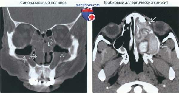 КТ, МРТ при поражении структур полости носа без деструкции костей