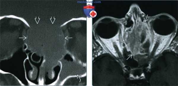 Синоназальный нейроэндокринный рак - лучевая диагностика