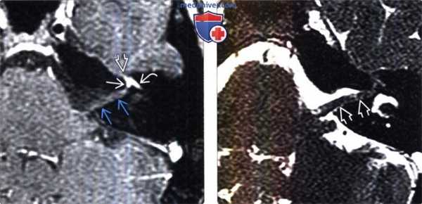 МРТ признаки паралича Белла