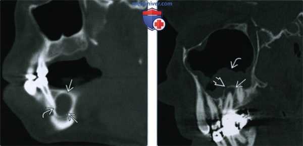 Периапикальная (радикулярная) киста - лучевая диагностика