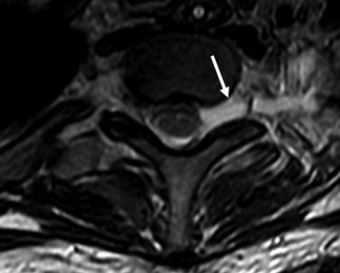 Псевдоменингоцеле