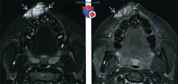 КТ, МРТ венозной мальформации головы и шеи