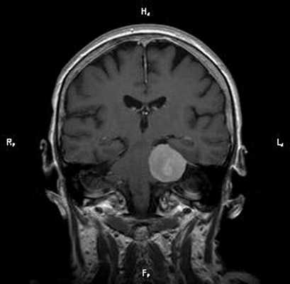Рис. 9. Пациент А., 66 лет. МРТ дна полости рта в сагиттальной проекции в режиме Т2-ВИ. Опухоль дна полости рта размерами 2,0х1,8 см с распространением на основание языка Т1N0M0 (стрелки). Границы опухоли четко визуализируются, структура однородная