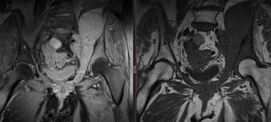 МР-томограмма костей таза