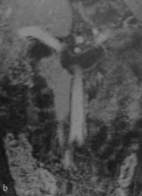 Снимки МРТ и КТ. Тромбоз почечной вены