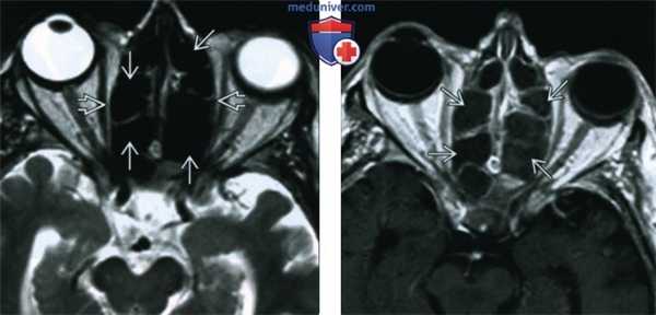Аллергический грибковый синусит - лучевая диагностика