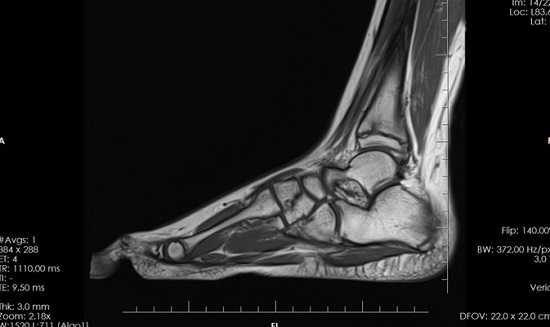 МРТ показывает кости