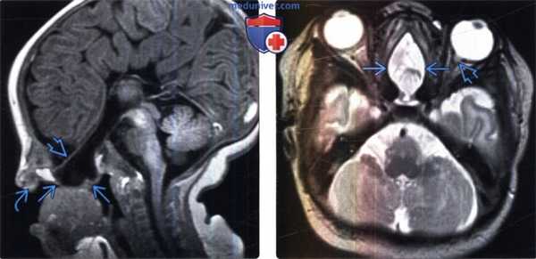 Цефалоцеле на КТ, МРТ