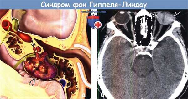 Синдром фон Гиппеля-Линдау на МРТ