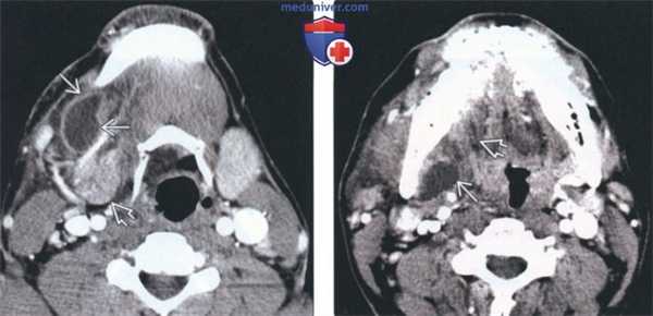 КТ, МРТ при рануле