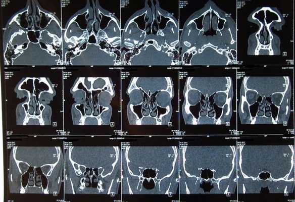 КТ или МРТ носа, что лучше
