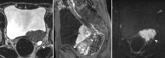 МРТ малого таза в диагностике заболеваний мочевого пузыря