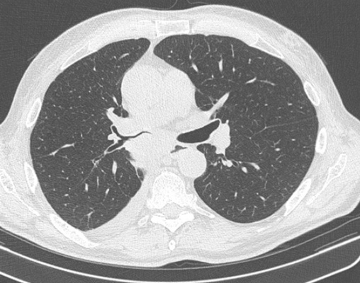 Центральный рак правого нижнедолевого бронха с обтурацией и метастазами
