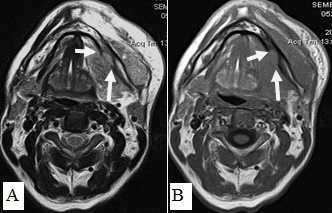 Рис. 15. Пациент С.,52 г. МРТ полости рта в аксиальной проекции в режиме Т2-ВИ (А) и Т1-ВИ (В). Рак дна полости рта с распространением на нижнюю челюсть, инфильтрацией мягких тканей щечной, подбородочной области слева. Выявляется деструкция кортикального слоя нижней челюсти слева, поражение костного мозга (стрелки)