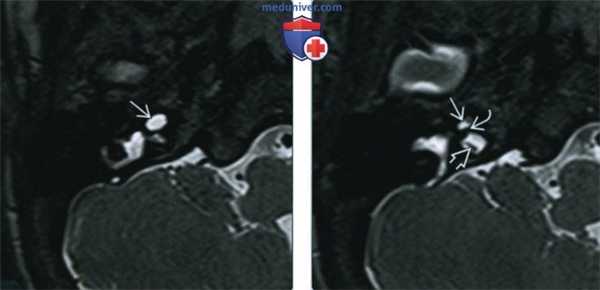 Аплазия улитки - лучевая диагностика