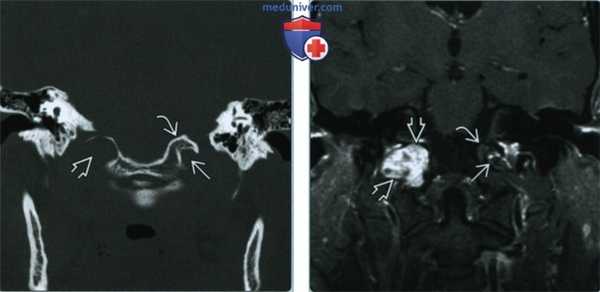 Шваннома подъязычного нерва - лучевая диагностика