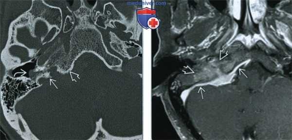 Менингиома яремного отверстия - лучевая диагностика