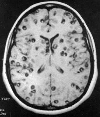 Снимки МРТ и КТ. Цистицеркоз ЦНС