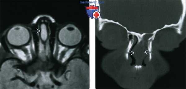 КТ, МРТ при дермальном синусе носа