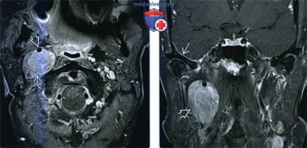 Менингиома сонного пространства - лучевая диагностика