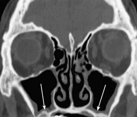 КТ носовых пазух (фронтальный срез). Стрелками отмечено утолщение слизистых оболочек