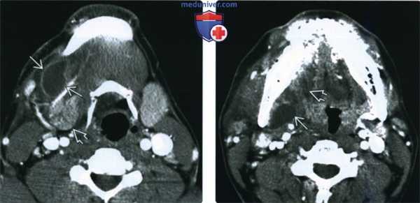 КТ, МРТ, УЗИ при рануле