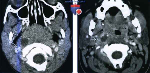 Нагноение заглоточных лимфоузлов - лучевая диагностика