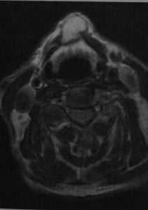 Снимки МРТ и КТ. Щитовидно-язычная киста