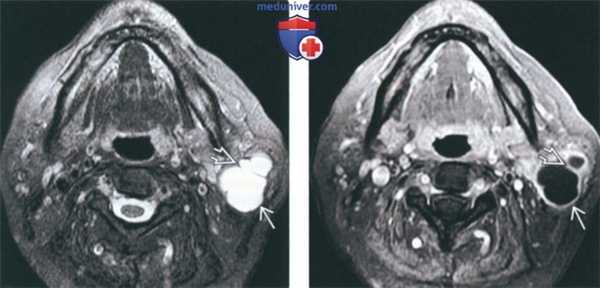 КТ, МРТ при опухоли Уортина