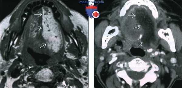 Моторная денервация подъязычного нерва - лучевая диагностика