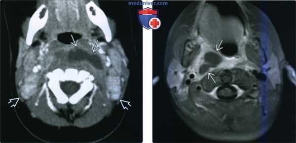 КТ, МРТ при заглоточном абсцессе
