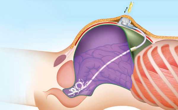 Перитонеальная порт-система