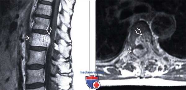 МРТ гемангиомы позвоночника