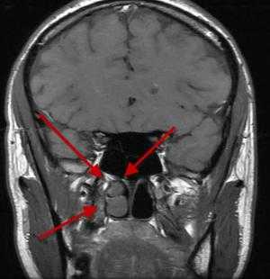 Что показывает МРТ аденомы гипофиза