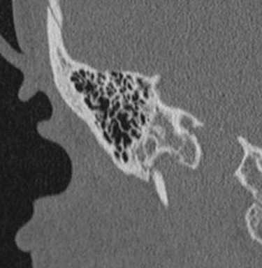 болезнь Меньера-фрагмент